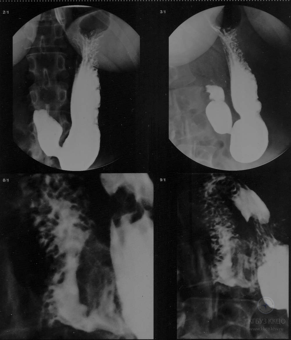 Рис. 2. Рентгеноскопия желудка больной М. В дистальном отрезке нисходящего отдела 12-перстной кишки по её внутреннему контуру краевой дефект наполнения с неровными контурами размером 30 х 15 мм.