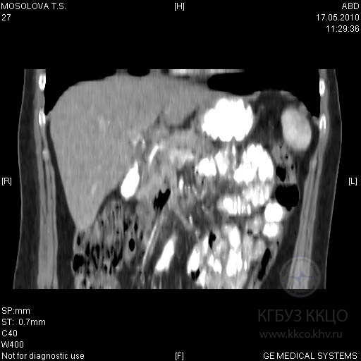 Рис. 3. Спиральная компьютерная томография органов брюшной полости больной М. через 13 месяцев после операции (объяснение в тексте).