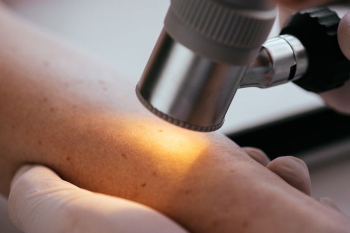 Бариатрическая хирургия способствует снижению риска развития злокачественных новообразований кожи